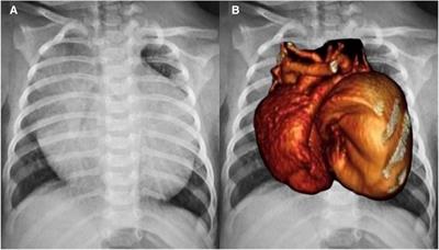 Case Report: One heart with two lobes: a rare infantile congenital giant left atrial appendage aneurysm